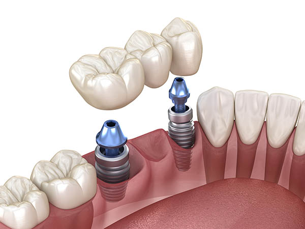 Dental Implant Bridge