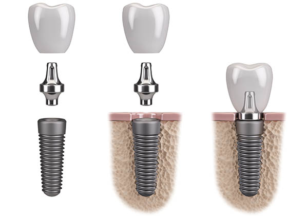 The Stages of Implant Therapy