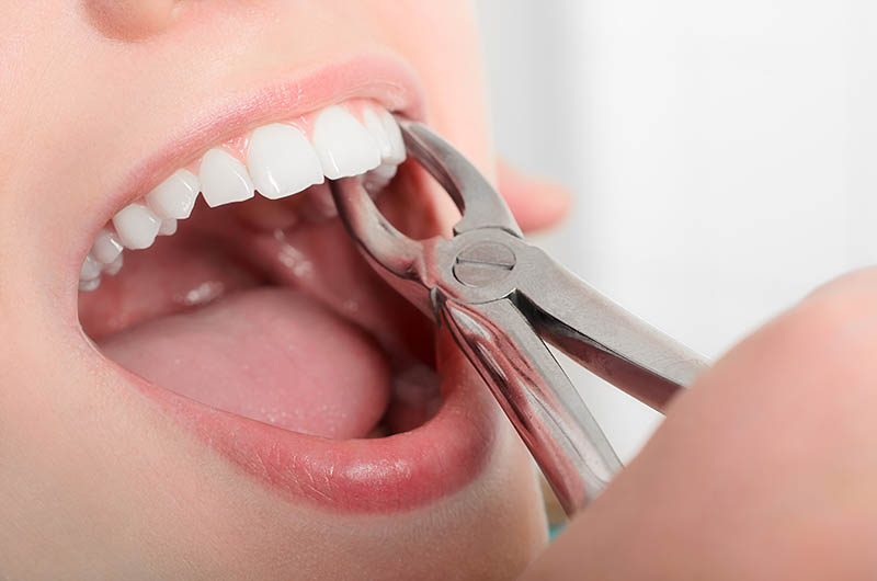 Information about dry socket and tooth extractions from your local