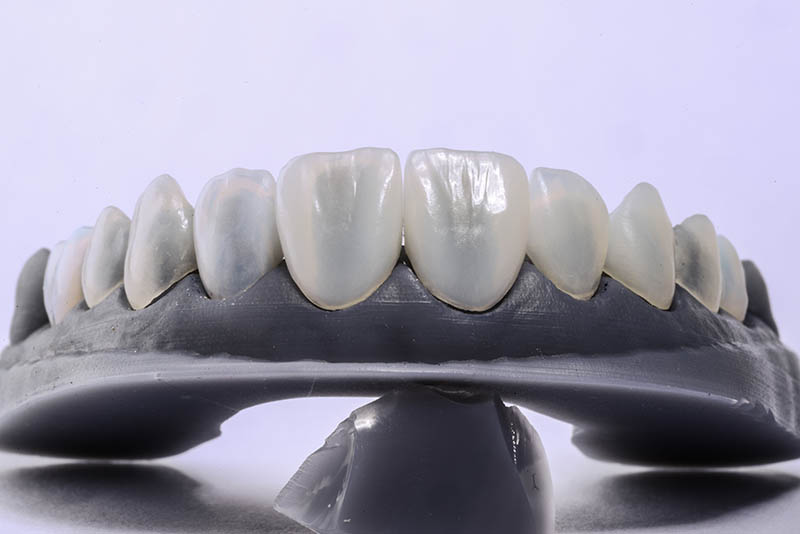 Step 3 of Porcelain Veneers: The Preparation Appointment & Your Temporaries