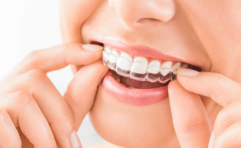 Ceramic Braces vs Invisalign: Which Is Right for You?