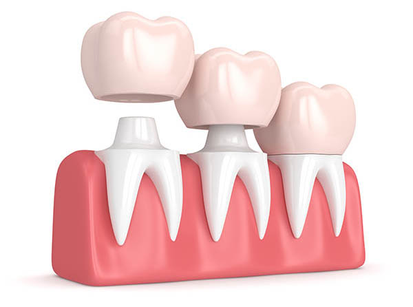 Dental Crown, Dental Cap