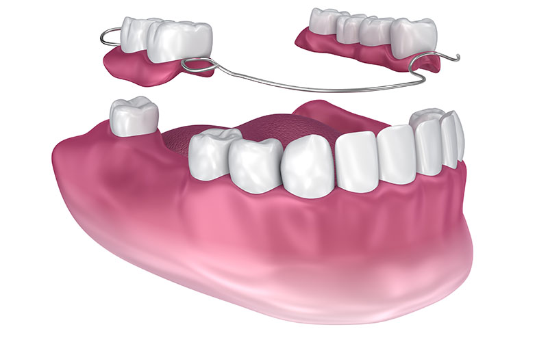 Partial Dentures