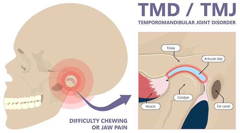 Temporomandibular Joint Disorders | Difficulty Chewing or Jaw Pain