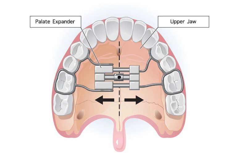 Palatal Expansion Make Types Cost Pros & Cons Who Needs