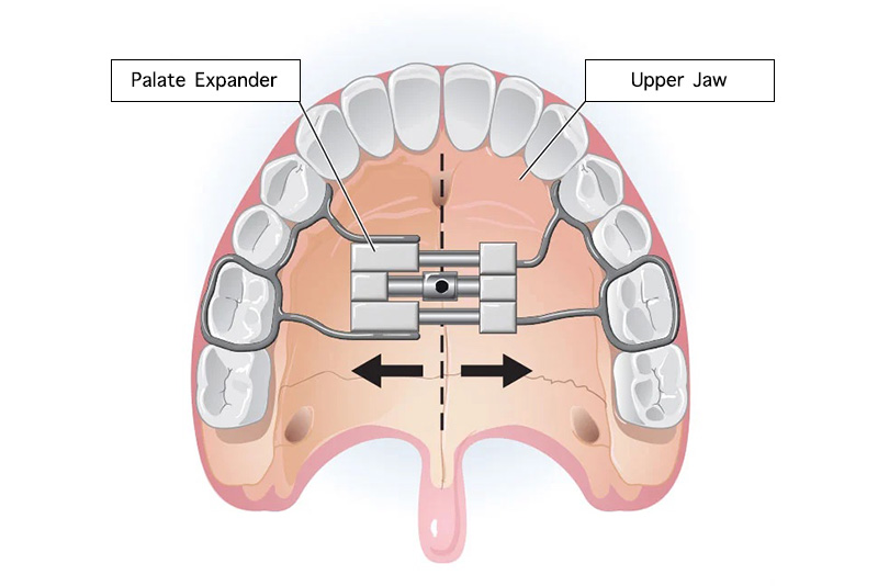 What is Palatal Expansion?