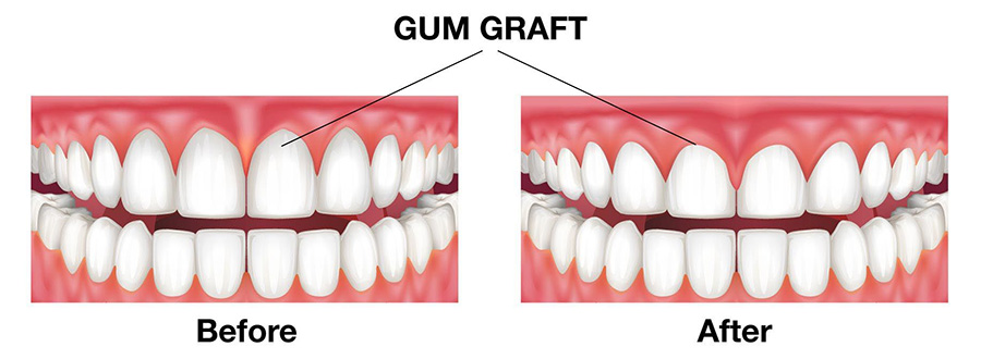 gum graft, gum grafting, gum graft before and after