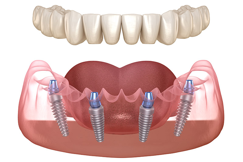 all on 4; all on four; all on 4 dental implants; all on four north york; dental implants; all on 4 lower jaw;